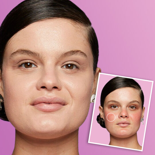 REDNESS & IRRITATIONS